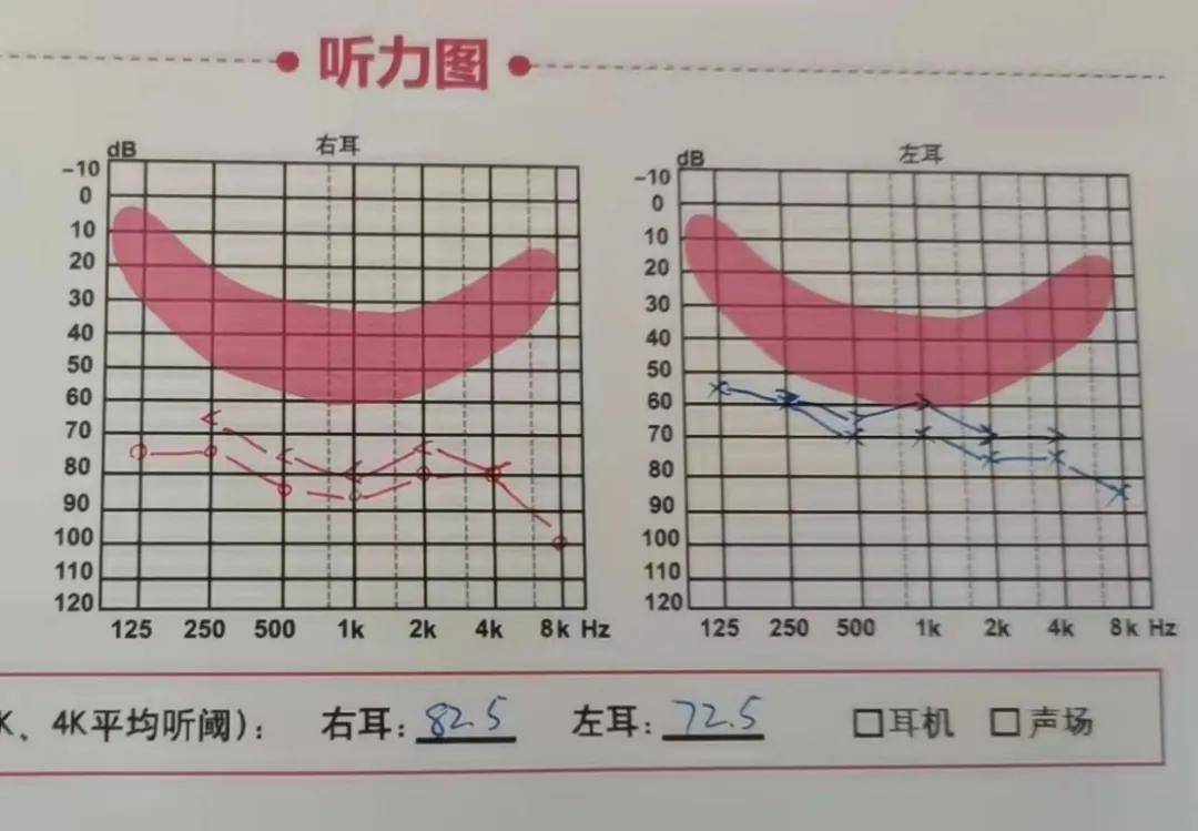 听力检查报告正常图图片