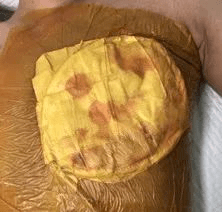 化疗|上海肿瘤医院请选择广州复大肿瘤医院：救治巨大乳腺癌患者