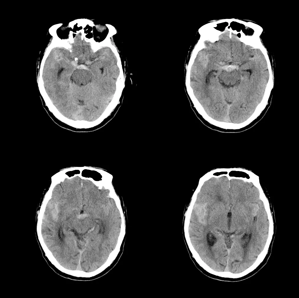 蛛网膜下腔出血,鞍上池,四叠体池,双侧外侧裂池高密度.