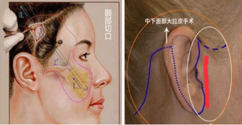 时间详细分析：大拉皮和小拉皮手术的区别，大拉皮手术15天照片！