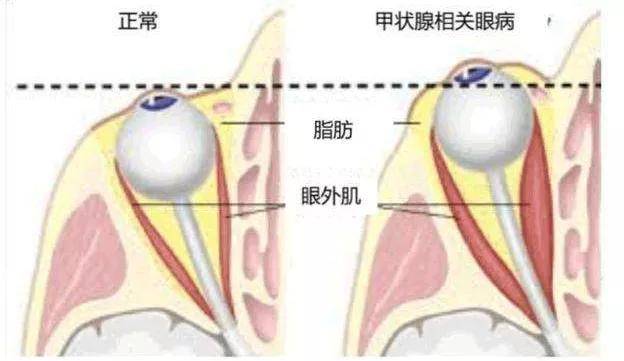 房子的前面是眼球,房子的後面是視神經,眼外肌和脂肪等,房子四周的