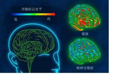 哈爾濱精神病醫院丨精神分裂症能治好嗎