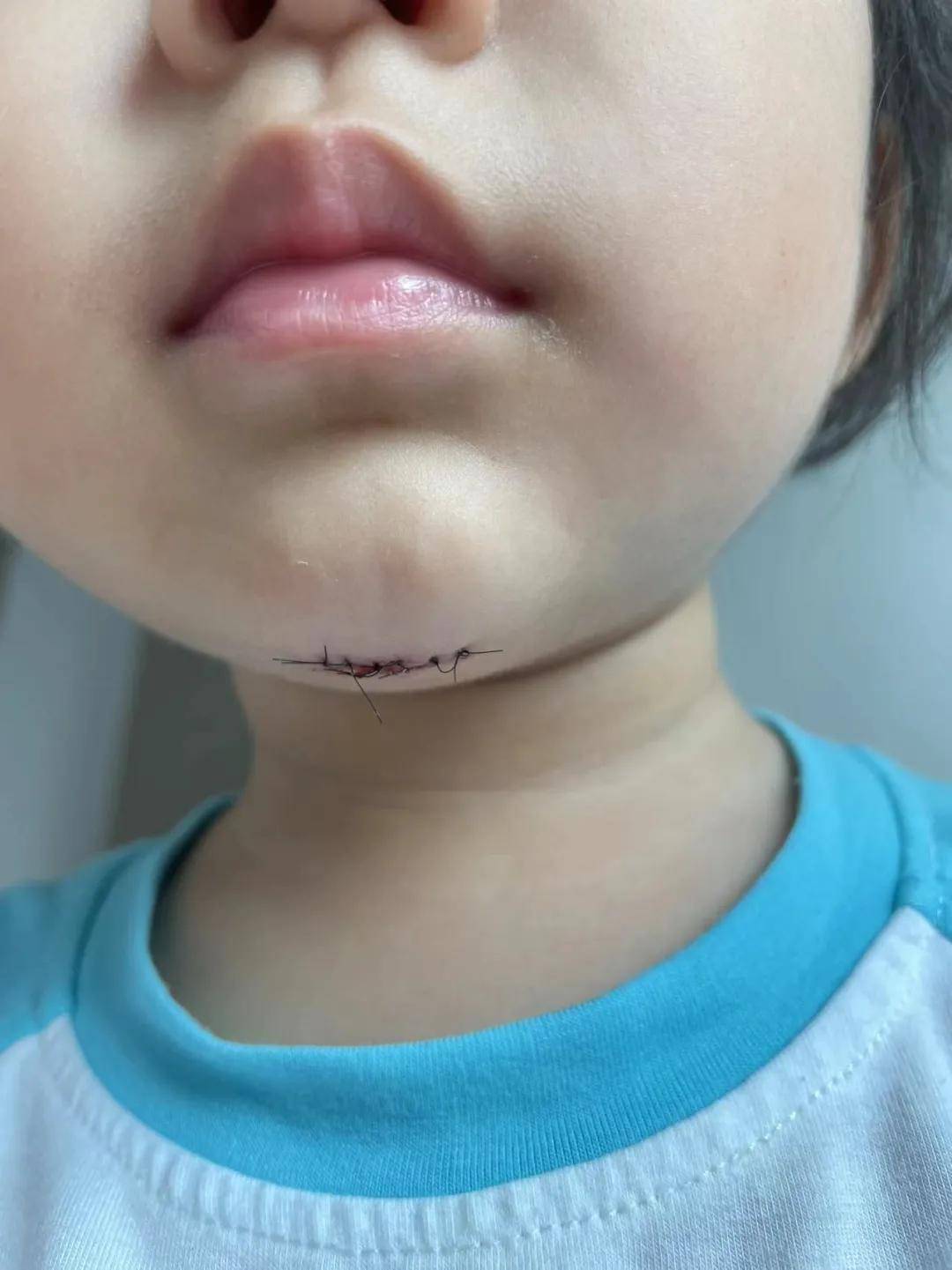 下巴|揪心！“1岁多女儿在新加坡幼儿园受伤缝6针，学校的态度令人心寒……”