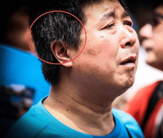 肝臟|肝不好的人，身體或有6個表現，占其一，肝或已“爛掉”