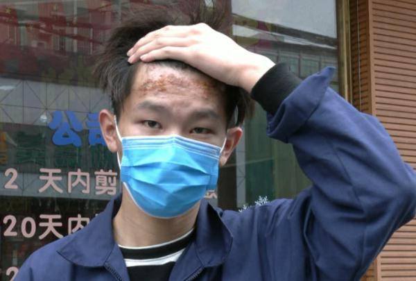 小伙烫发有风险？一小伙做“烟花烫”被烧伤，额头烫成这样！