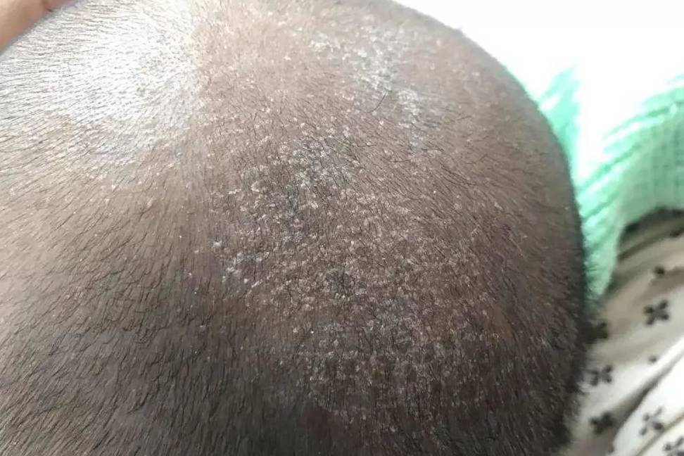 婴儿头垢是什么样子 b2f4dd3e19f342cd8aa87cc2828e7104.jpeg