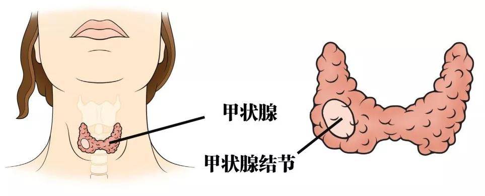 甲状腺结甲结节 来自搜狐网
