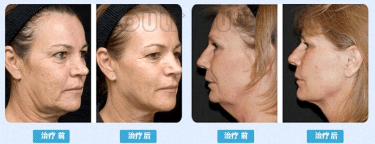 进行涨知识:筋膜悬吊提眉效果可保持多久?筋膜提升术后注意事项谁知?