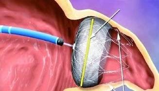 吃什么东西对心脏和心血管最好 cafde68e2e6d47028c647f219a35a9b9.jpeg