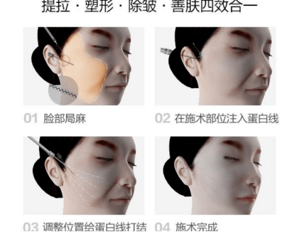 什么黄金微雕和线雕有什么区别？法令纹做线雕效果怎么样？