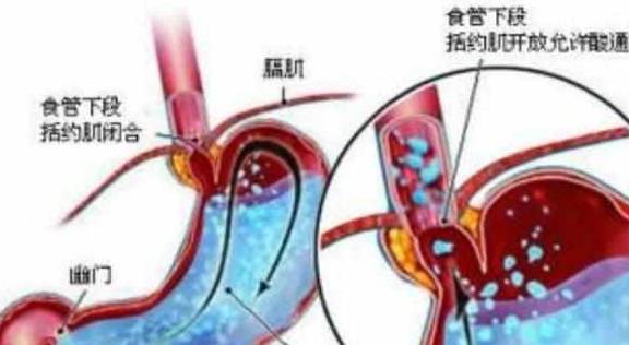 括约肌|胃食管反流是因为胃酸太多导致的吗？那么该怎么办呢？