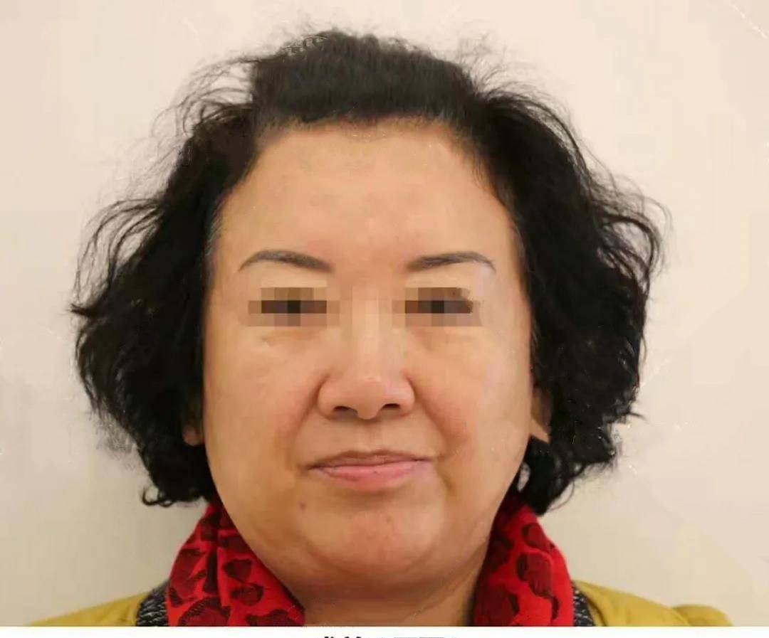 大姐60岁大姐面部提升真实经历：术后10天换脸实拍，为了美她也是拼了