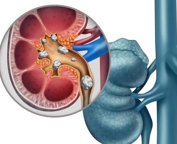 预警|肾结石并非&quot;哑巴&quot;4个预警出现，就要小心警惕