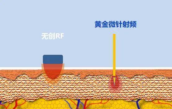 玛吉医美科普 | 抗衰选热玛吉还是黄金微针哪个好？