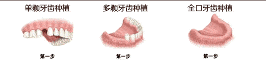 牙没了想补牙,选烤瓷牙还是种植牙?