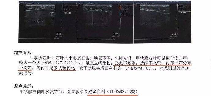 可能预示恶性的风险大,需及时就医进一步排查:注重b超检查