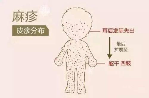 幼儿急疹身体出疹顺序图片