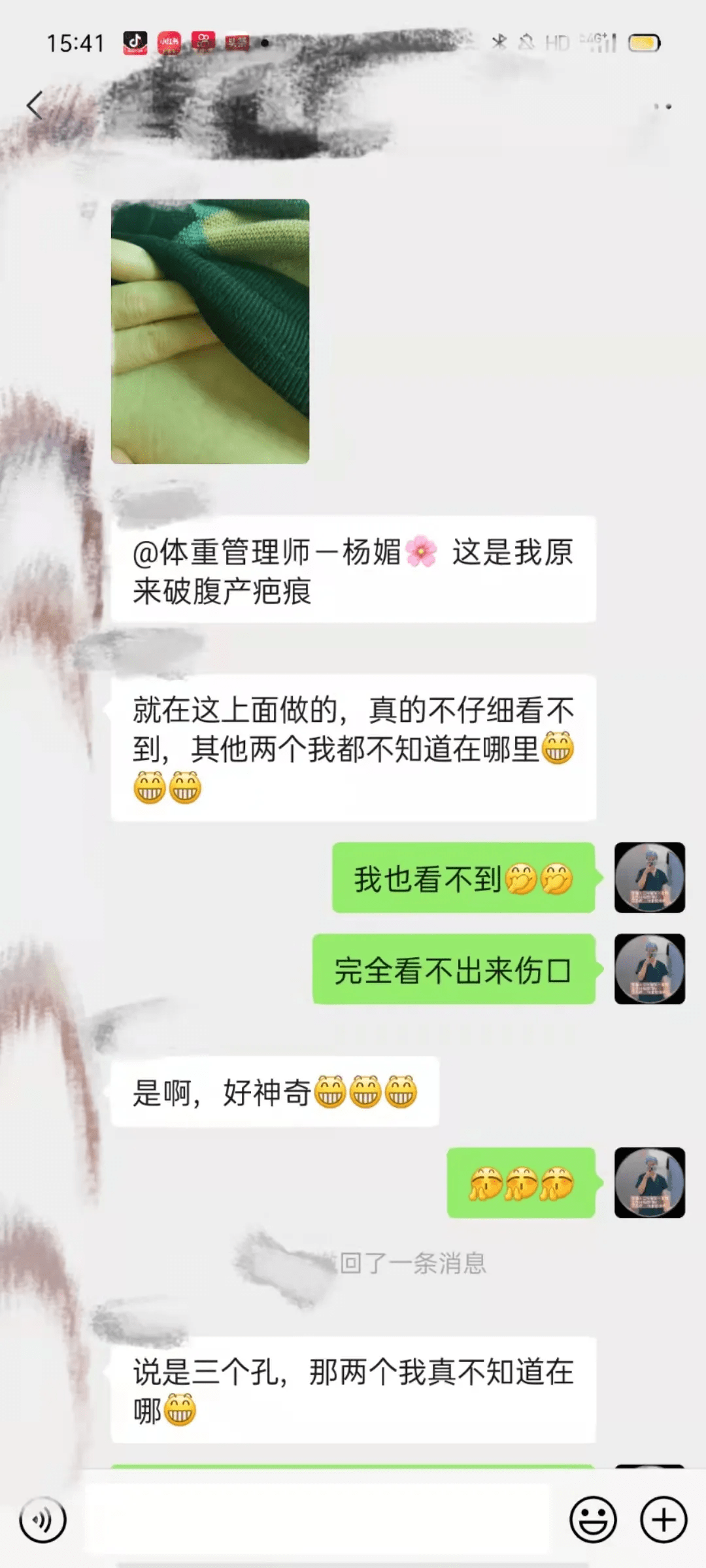 腹腔镜|担心做完减重手术伤口会影响美观？