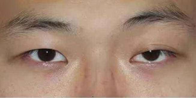 因为北京西美整形外科的刘野院长：眼睛看起来大小不一样具体怎么改善
