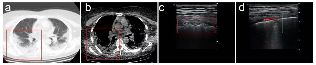 胸科医院|西安市胸科医院新冠超声影像技术新进展登上国际著名影像学论坛AuntMinnie.com