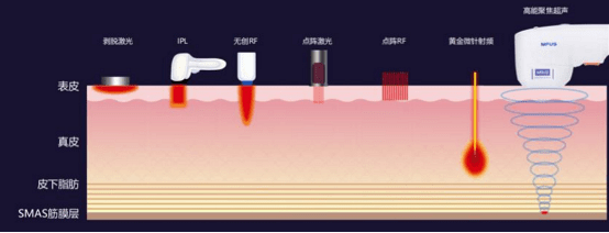 能量超声刀美容恢复期多久？扒皮超声刀美容适合年龄？你中招了吗？