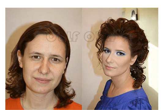 分析分析:热玛吉后多久可以打水光、做完热玛吉多久可以化妆~