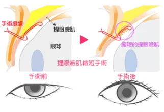 进行西安国际医学中心孙峰主任连线西安交通广播电台 畅聊眼修复和上睑下垂