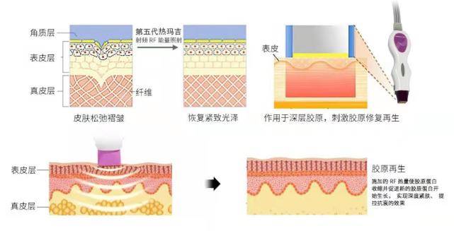 玛吉热玛吉保持时间是多久，热玛吉不做以后会老得更快吗