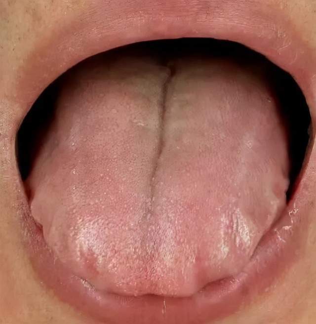 舌头有裂纹问题可能在脾胃1张方子养脾胃养舌改善裂纹舌