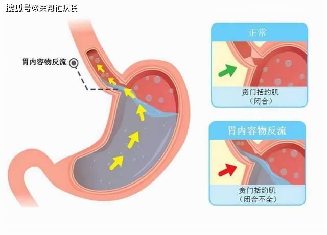 胃食管反流病一般有什么反应?出现反酸,烧心等,应该怎么做?