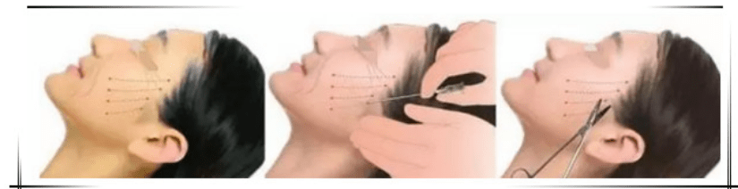 什么科普篇：ppdo线雕是什么线？ppdo线雕维持时间？