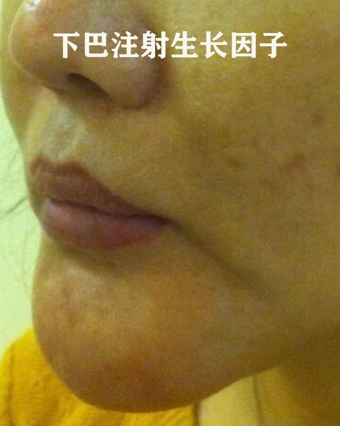 下巴40岁后如何避免在医美抗衰项目上“踩雷”，医生总结告诉你