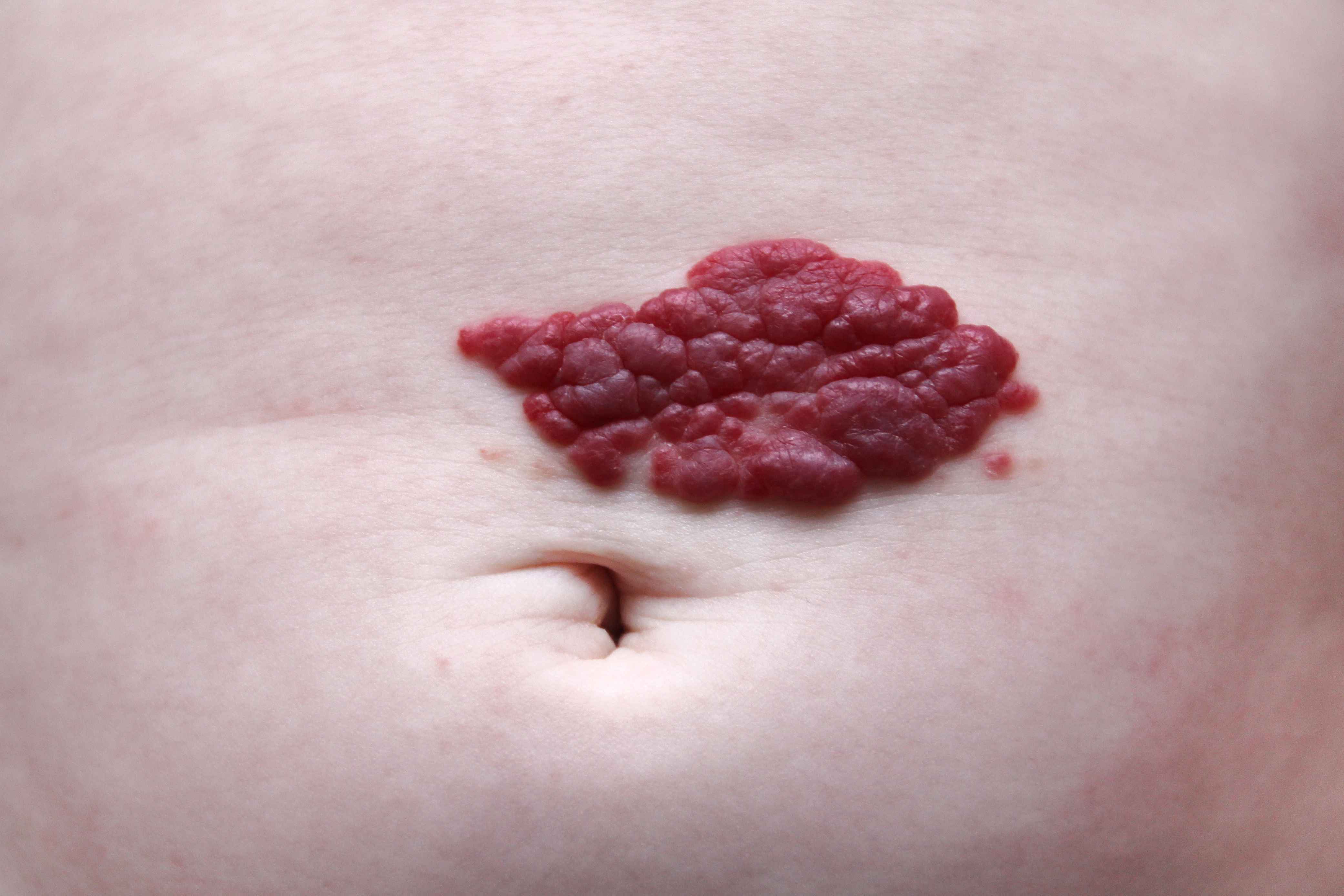 皮肤上长红色血管瘤图片
