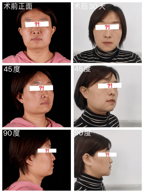 整形咬肌肥大、下颌角肥大、脂肪多的脸型应该怎么改善？|整形医生籍建华