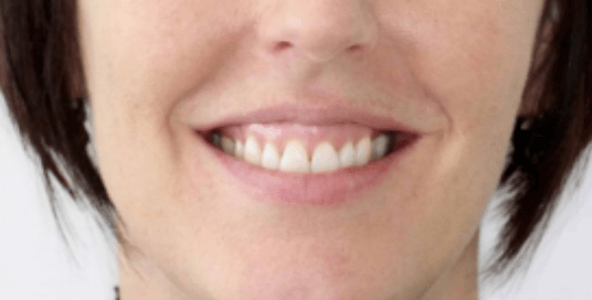 梅尔国际快讯 | 过度的使用注射剂后,你的笑容会被改变吗?