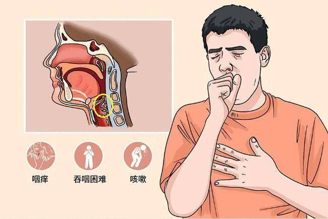 肺部有疾，喉咙先知，别再当作咽炎了，医生：尤其出现2个信号