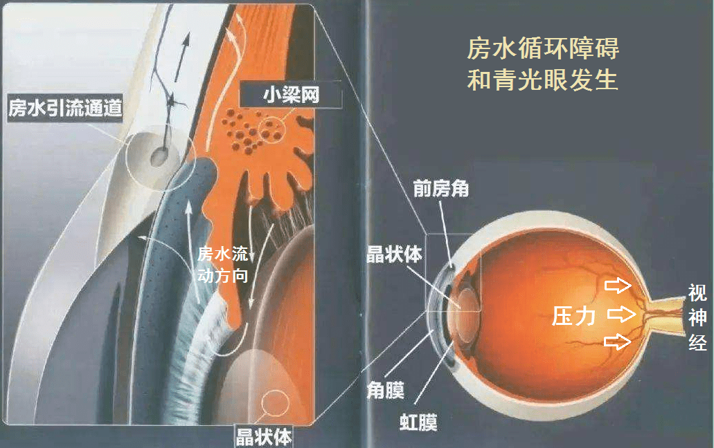 【世界青光眼日】"狡猾"的青光眼_眼压_患者_眼球
