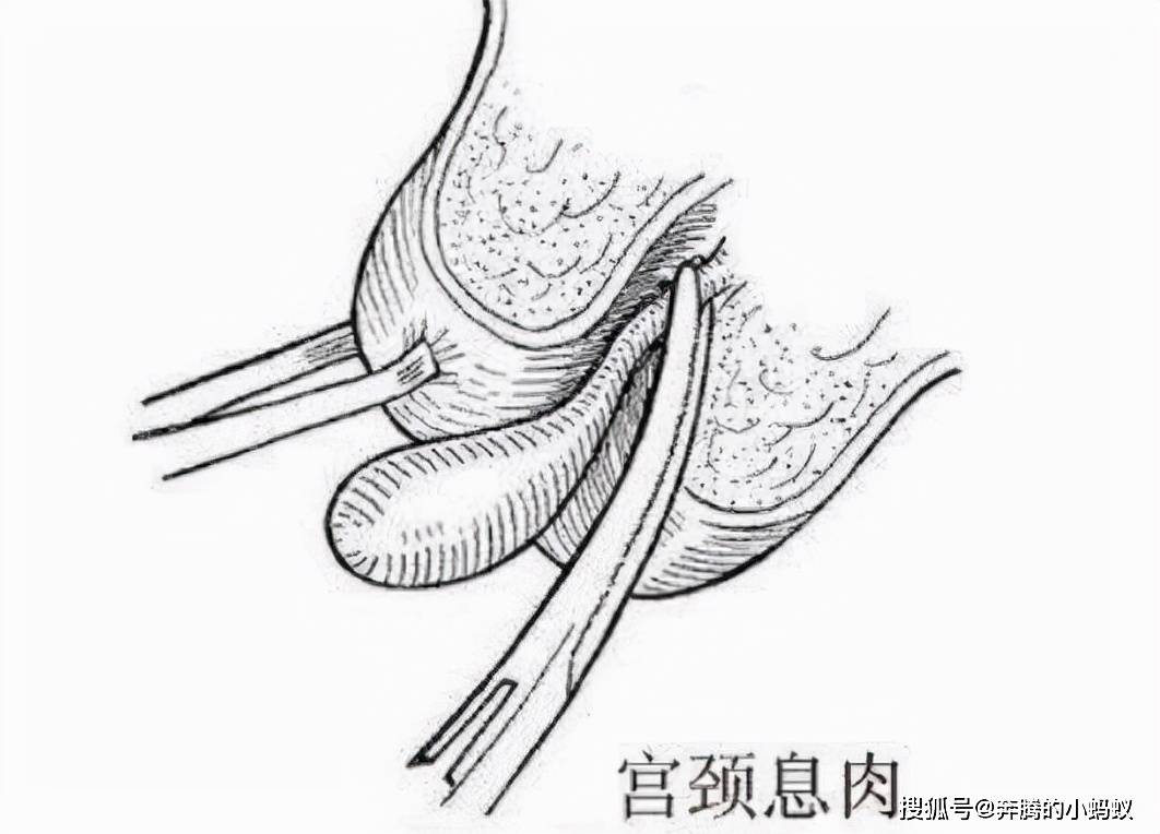 宫颈锥切手术全过程图片