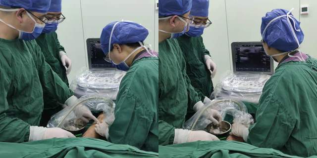 成形术|兴国县人民医院顺利实施首例超声引导下经皮腔内血管成形术