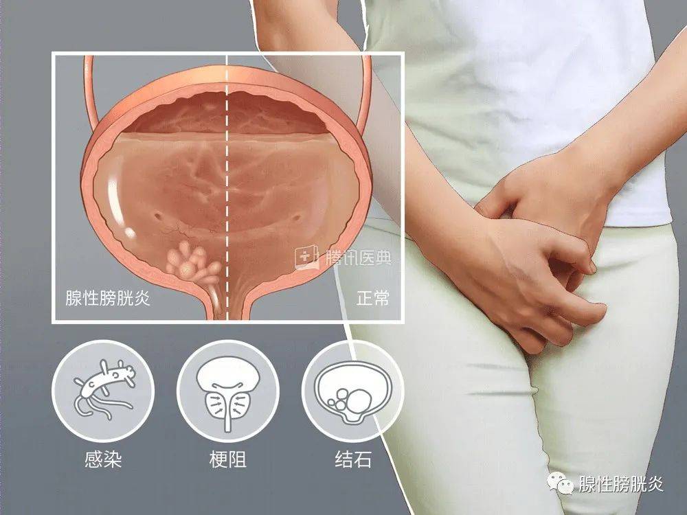 女性检查尿道尿道炎图片