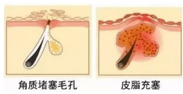 黑头黑头粉刺怎么去，这几招还你干净平滑的脸！