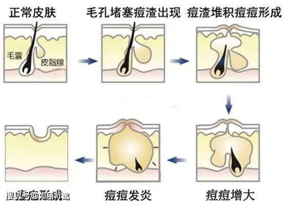 治疗痘痘只能靠医美手段改善吗？