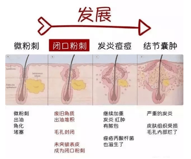 黑头黑头粉刺怎么去，这几招还你干净平滑的脸！