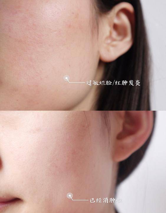 兰蔻好爽肤水倒手上就开始拍？医生哭笑不得：果然是人傻钱多！