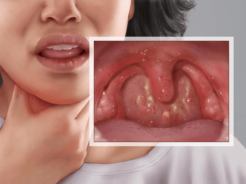 过敏性咽炎什么症状图片