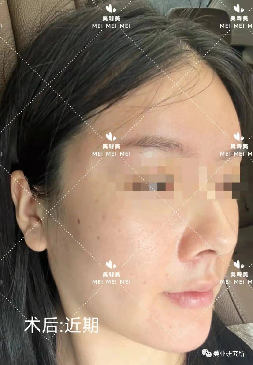 消息资讯【美人汇】拯救痘痘肌，还原婴儿肤