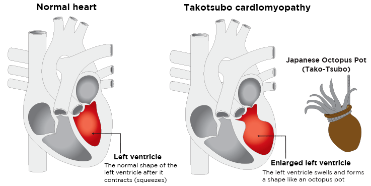 "takotsubo"一词来自于日本一种捕章鱼的罐子,瓶颈