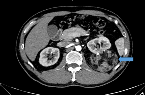 發現患者左側腎臟錯構瘤體積巨大,且部分腫瘤組織深深扎入腎實質中