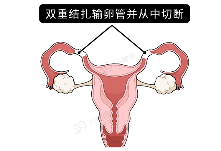 《男女结扎大对比》今天九叔就来讲一期了解结扎这件事为了让各位更