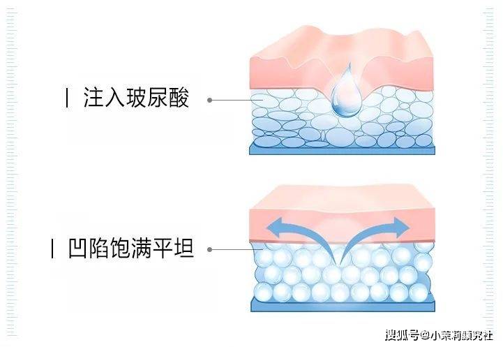 人体玻尿酸和胶原蛋白哪个更适合你？